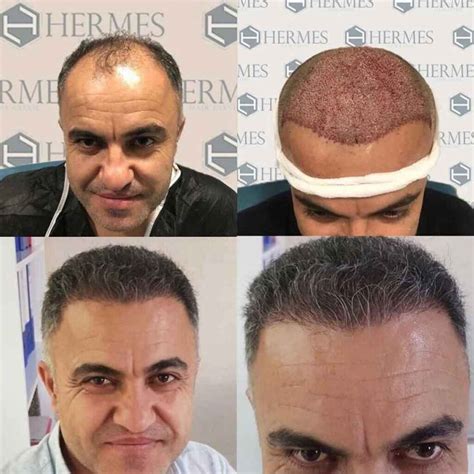 hermest hair transplant cost